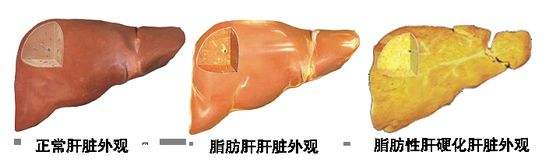 肝脏外观变化