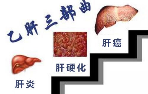 肝癌三部曲